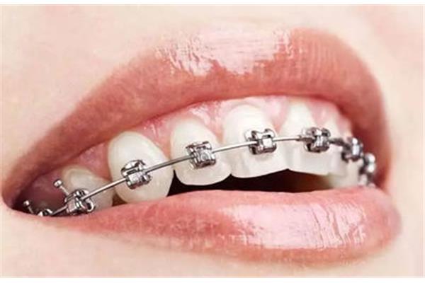 單牙制作牙套和單牙制作牙套的過程