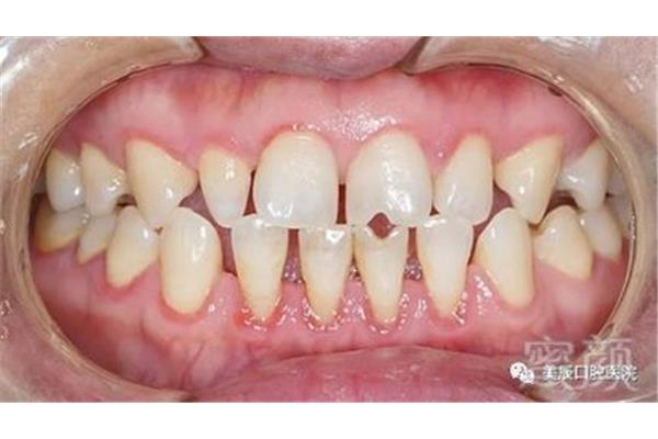 修补过的大牙能用多久