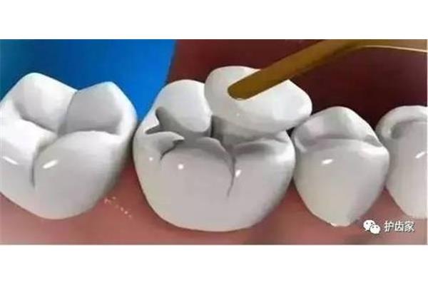 补牙的树脂材料能用多久(补牙的3m树脂材料能用多久)?