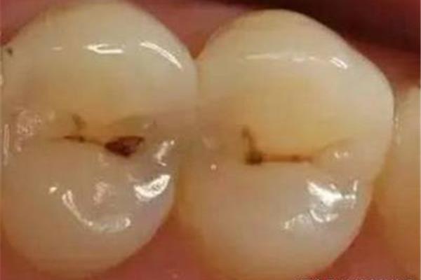 牙齿多久蛀到牙髓