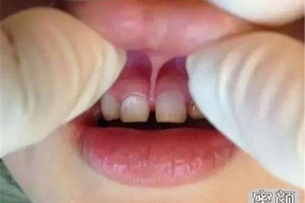 牙齒系帶切除手術時間多久