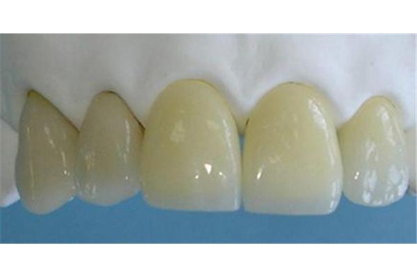 根管修復和樹脂修復后的牙齒可以用多久?
