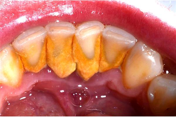 洗牙沒多久,又有牙結石了為什么洗牙后沒有再出現牙結石?