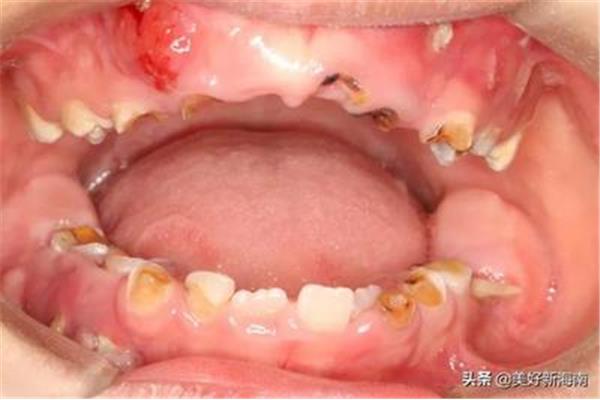 补一颗简单的牙要多久,会痛吗(为什么蛀牙会痛?)