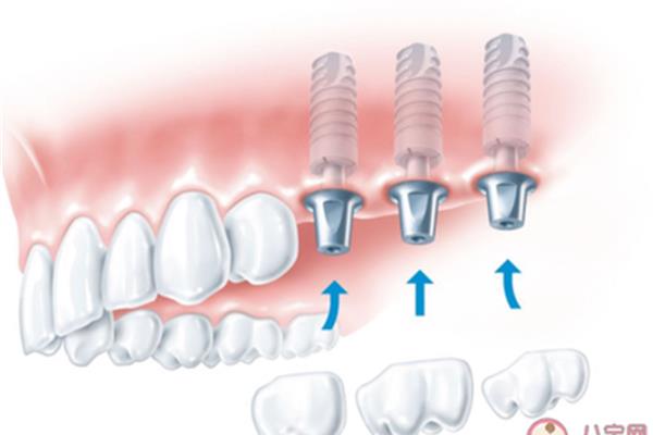 智齒拔除后需要多長時間恢復,拔牙后幾天恢復正常?