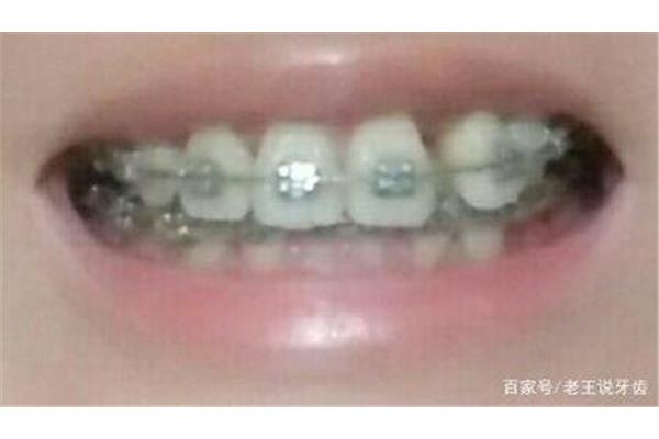 牙套的过程(取下牙套的时候需要戴固位体吗)