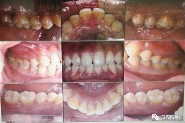 牙根外露的牙齒可以用多久?智齒牙根斷了還能長好嗎?