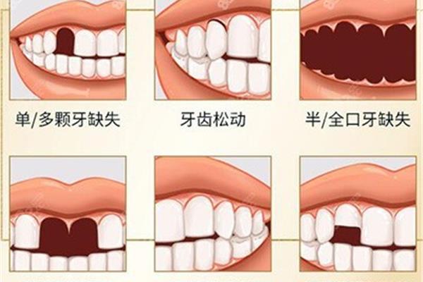 种植大牙的全过程(牙的全过程)