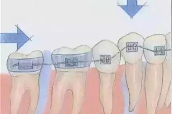 矫牙牙齿多久会移动