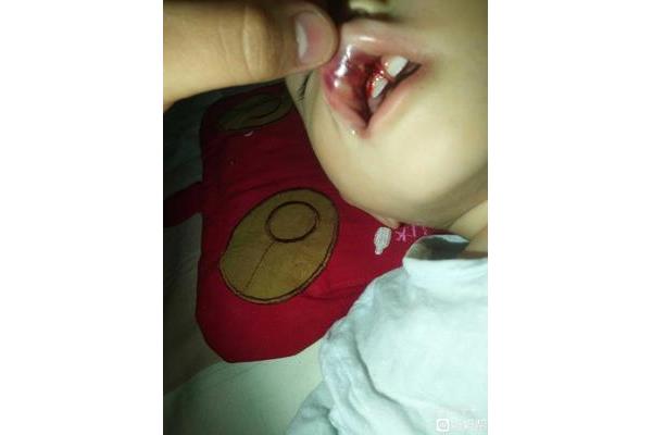 一岁宝宝摔倒牙龈开裂(关于裂牙问题)