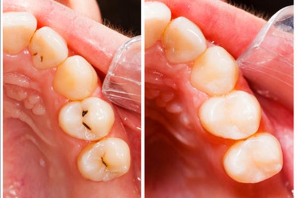 有牙洞补牙洞需要多久