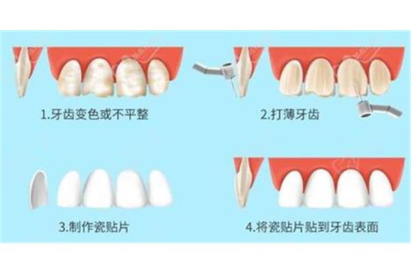 牙齿贴面的保质期是多久(做牙齿贴面要多久)