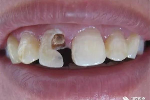 牙体打桩和牙冠安装的寿命有多长(第六颗牙根管治疗多少钱)