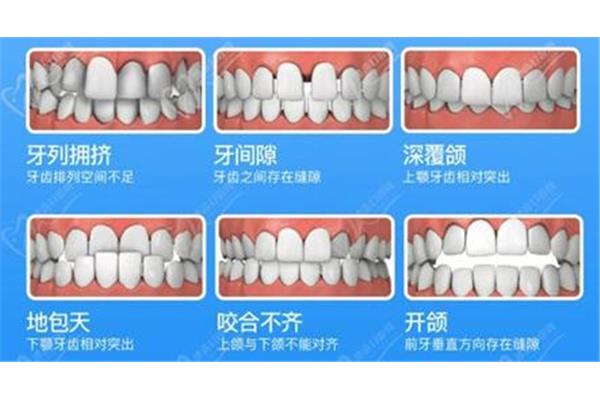 牙齿矫正一般需要多久(牙齿矫正的最佳复查时间是多久)
