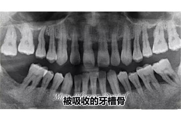 我的牙槽骨不见了能再生吗(拔牙后牙洞多久能愈合?)