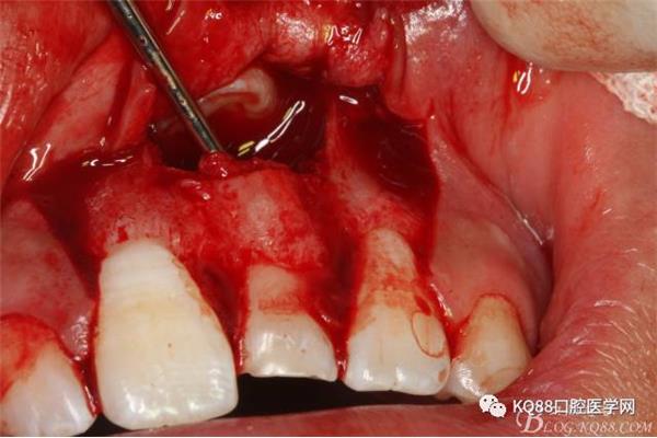 拔埋伏牙過程手術多久