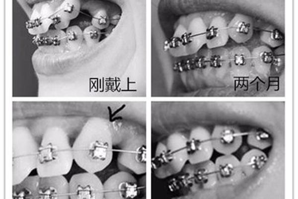 矯正牙齒的整個過程要多久
