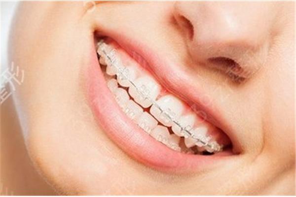 整牙做牙套要多少钱(牙套会导致牙齿过早脱落吗?)