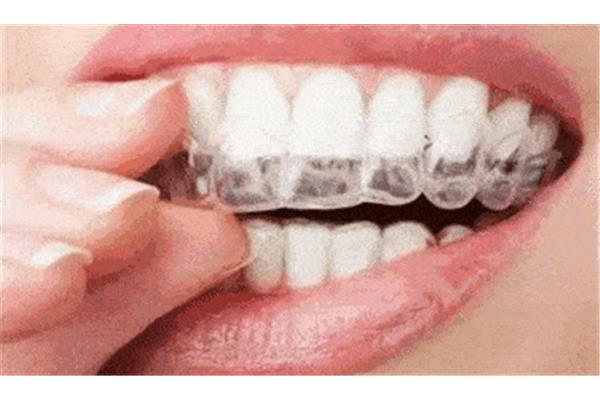 摘牙套后牙齒需要多久才能進入穩定期,摘牙套需要多久?