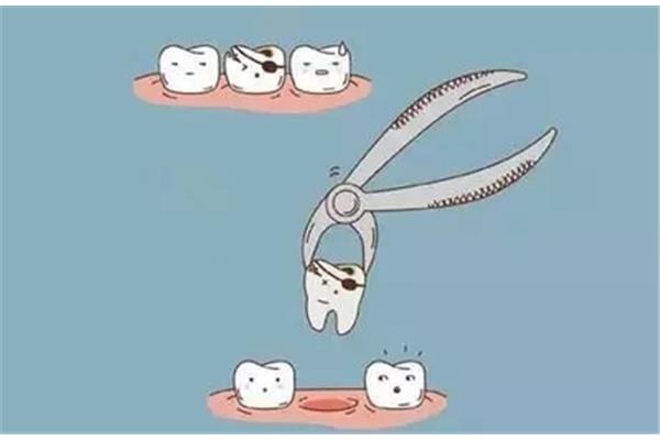 拔牙后多久可以裝假牙,拔牙后多久可以裝假牙?