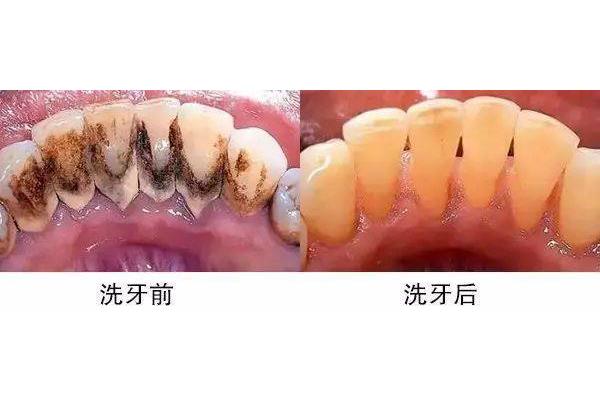 牙石很多 洗牙要多久