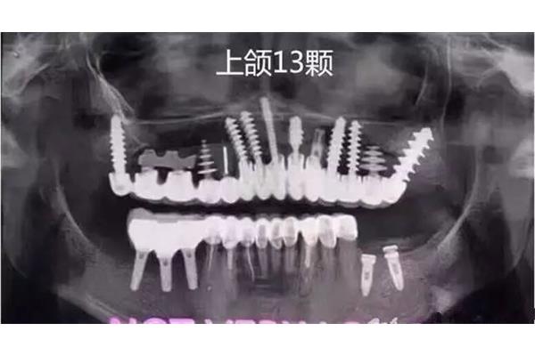 牙科的X片有效多久