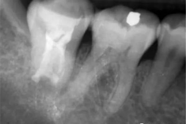 牙再植后牙齿变黑需要多久(牙再植后根管治疗需要多久)