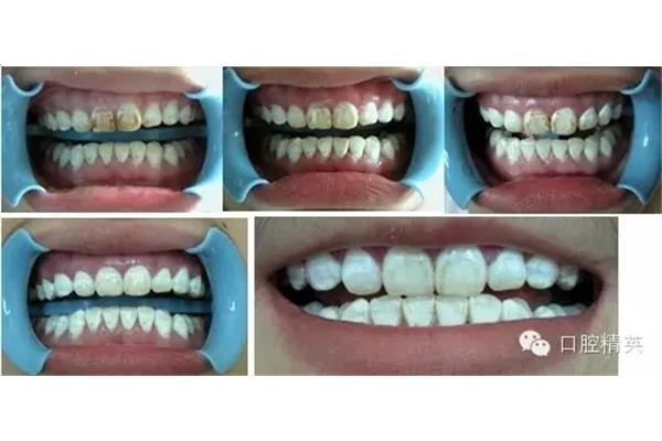 化學漂白牙齒能堅持多久?牙內漂白會影響牙齒壽命嗎?