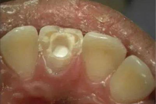 牙齒根管治療超過根尖怎么辦?牙齒的根管治療疼嗎?