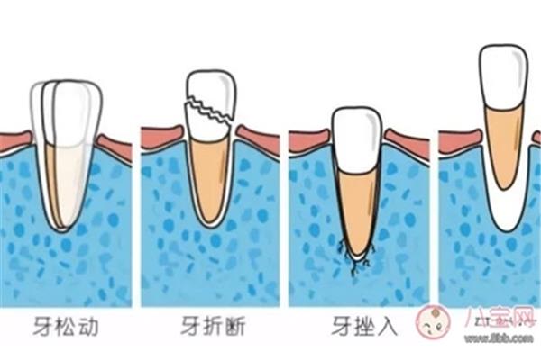 牙外伤松动牙齿需要多久(牙外伤松动2度固定需要多久)