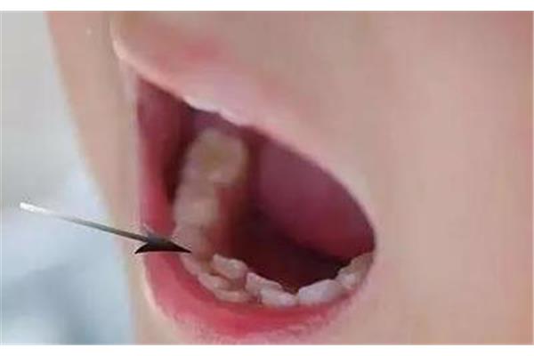乳牙拔掉后多久會長出來?孩子乳牙拔掉應該注意什么?