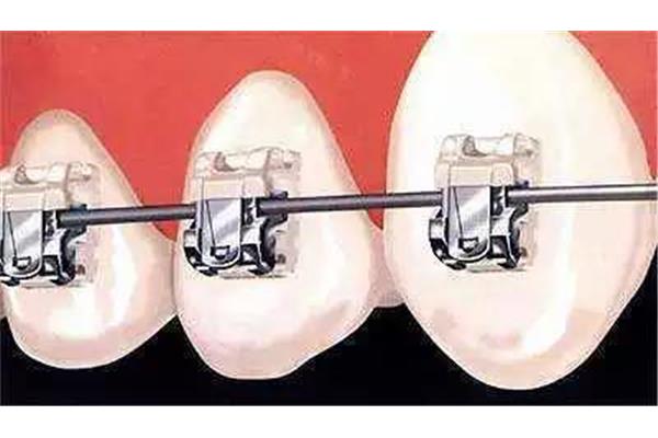 牙齒矯正會讓牙齒松動嗎?正畸后會松動嗎?