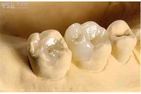 補牙用樹脂的優缺點,門牙有裂縫怎么辦?