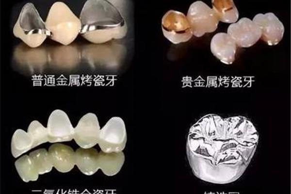 真正的全瓷牙能用多久