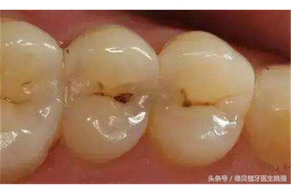 从确诊到带牙套需要多久