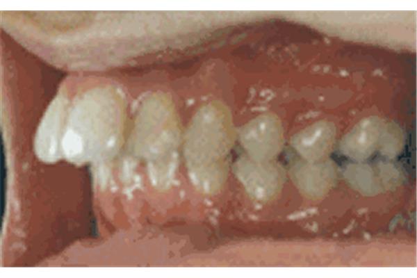 牙齒戴牙套需要多久,牙齒戴牙套需要多久?