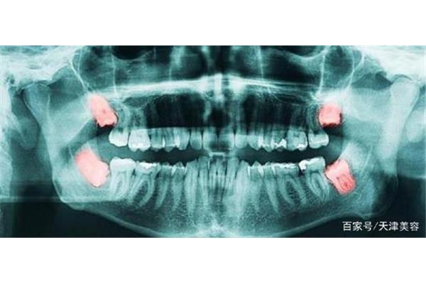 拔牙后牙齒需要多久才會移位,智齒需要多久才能愈合?