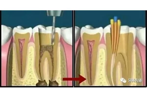 牙齒根管充填視頻,牙齒根管充填后疼痛怎么辦?