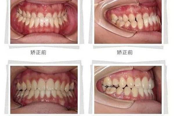 牙套矫正牙齿需要多长时间?(智齿拔了可以做正畸吗?)