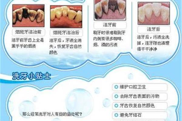 洗牙多久 治疗牙周