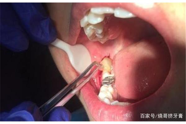 一顆牙傷口愈合需要多長時間,一顆牙傷口無痛拔除需要多長時間?