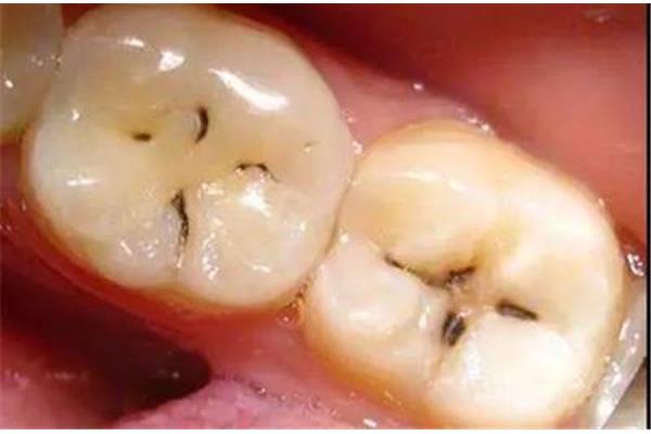 牙齒窩溝齲多久會壞