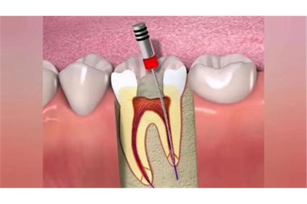 牙科治療一次根管治療要多久,根管治療需要多長時間?