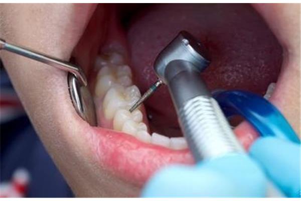 拔牙后牙齿疼多久(为什么补牙要钻牙是酸的?)