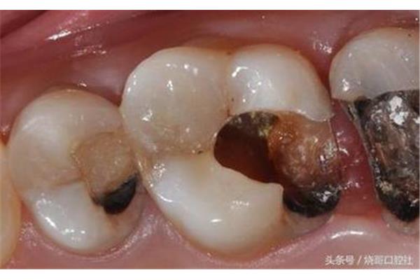 如何判断一颗蛀牙是否已经到了牙根(蛀牙的过程是怎样的)