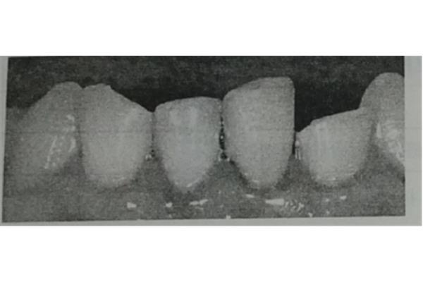 根管治療后牙齒會疼多久?根管治療后還是會疼