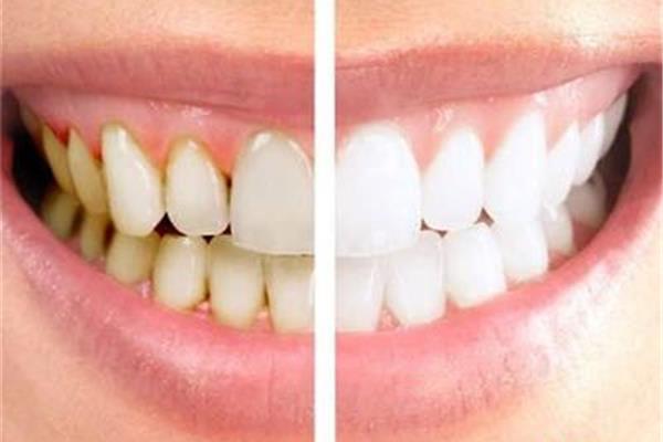 給牙齒裝牙套需要多長時間?帶牙套的牙齒向外突出