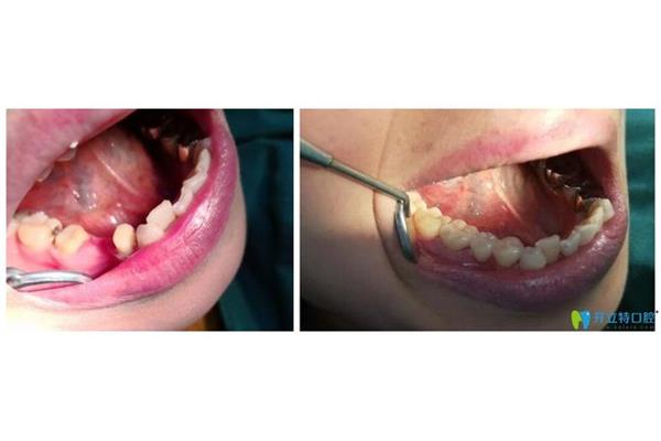 口腔赝复体可以使用多久