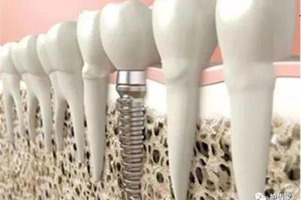 牙瘾裂的树脂修复能坚持多久(牙齿断裂修复需要时间)