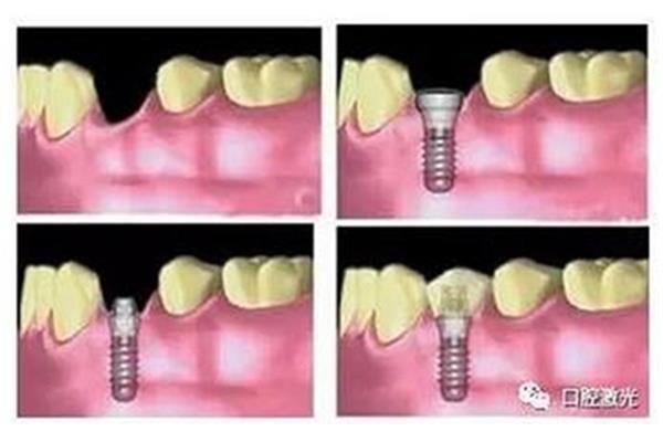 种植牙手术需要多长时间?(种植牙二期多长时间?)